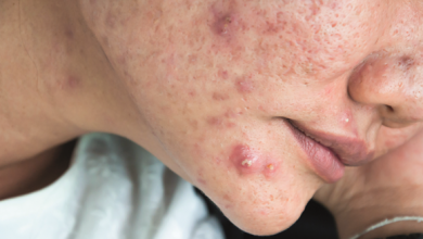 Photo of Secret: Get Rid Of Acne (Pimples) Completely