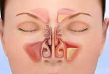 Photo of 18 SIGNS AND SYMPTOMS OF SINUS INFECTIONS