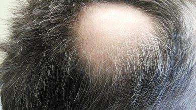 Photo of How To Recover Sudden Hair Loss Naturally