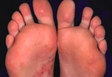 Photo of HOW TO GET RID OF MICROSCOPIC  FOOT FUNGI