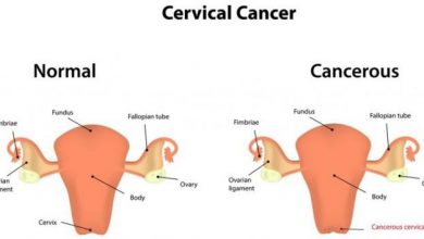 Photo of SYMPTOMS AND POSSIBLE PREVENTION OF CERVICAL CANCER