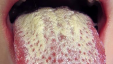 Photo of 7 HOME REMEDY FOR MOUTH YEAST (Oral Thrush)