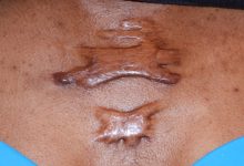 Photo of Causes And Remedy Of keloid You Dont Know