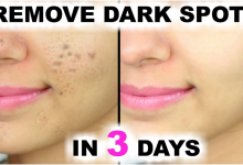 Photo of 4 POWERFUL HOME REMEDY TO REMOVE DARK SPOT IN 3 DAYS