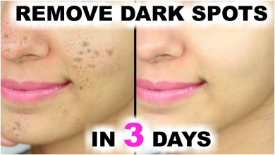 Photo of 4 POWERFUL HOME REMEDY TO REMOVE DARK SPOT IN 3 DAYS