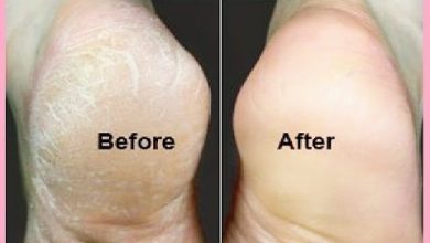 Photo of GET RID OF CRACKED HEELS