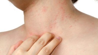 Photo of SIMPLE REMEDIES FOR ITCHY ECZEMA