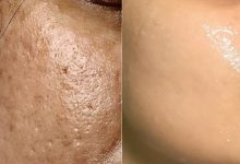 Photo of HOME REMEDIES FOR LARGE PORES