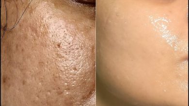 Photo of HOME REMEDIES FOR LARGE PORES