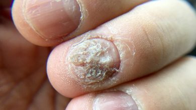 Photo of REMEDIES TO GET RID OF NAIL FUNGUS