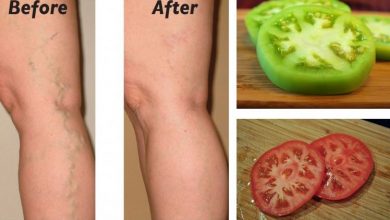 Photo of Home Remedy for Varicose Veins
