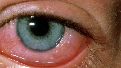 Photo of TIPS TO HELP YOU TACKLE EYE ALLERGIES