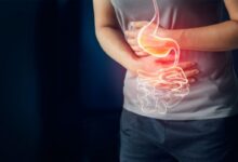 Photo of HOW TO TREAT AND PREVENT APPENDICITIS NATURALLY