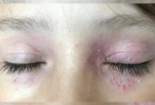 Photo of EASY HOME REMEDIES FOR SOOTHE IRRITATED SKIN AROUND THE EYES
