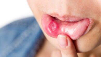 Photo of HOME REMEDY TO  MOUTH ULCER USING HONEY