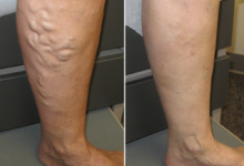 Photo of NATURAL REMEDIES AND PREVENTION OF VARICOSE VEINS