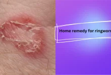 Photo of 10 Natural Home remedy for ringworm for Quickly result