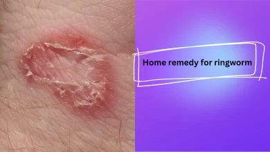 Photo of 10 Natural Home remedy for ringworm for Quickly result