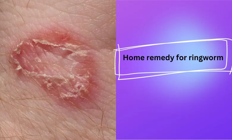 home remedy for ringworm