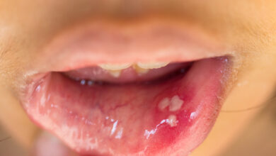 Photo of 7 WAYS TO GET RID OF CANKER SORES