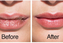 Photo of HOME REMEDY FOR CHAPPED LIPS