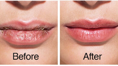 Photo of HOME REMEDY FOR CHAPPED LIPS
