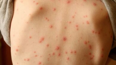 Photo of 7 EFFECTIVE HOME REMEDIES FOR CHICKEN POX