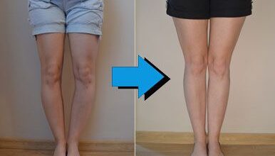 Photo of REMEDY FOR BOW LEGS WITHOUT THE NEED FOR SURGERY