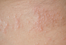 Photo of 11 NATURAL WAYS TO GET RID OF HEAT RASHES