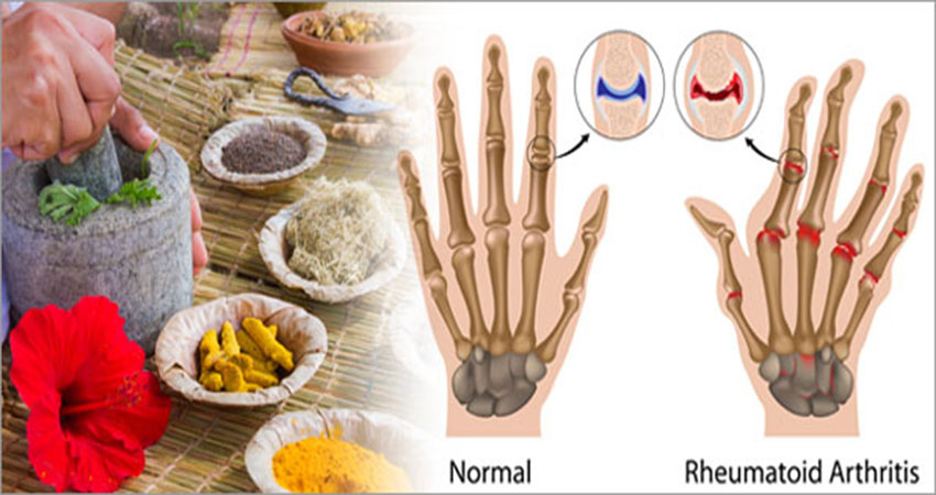 Photo of 9 Herbal Remedies For Treating Rheumatoid Arthritis