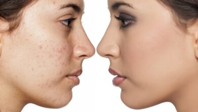 Photo of POOR HYGIENE HABITS THAT CAUSES SPOTS AND PIMPLES