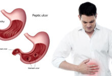 Photo of EARLY SYMPTOMS OF STOMACH ULCER TO WATCH OUT FOR