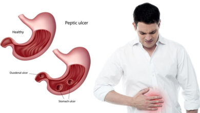 Photo of EARLY SYMPTOMS OF STOMACH ULCER TO WATCH OUT FOR