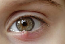 Photo of HERBAL REMEDY FOR EYELID CYST (CHALAZION)