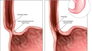 Photo of ACHALASIA: ALL YOU NEED TO KNOW