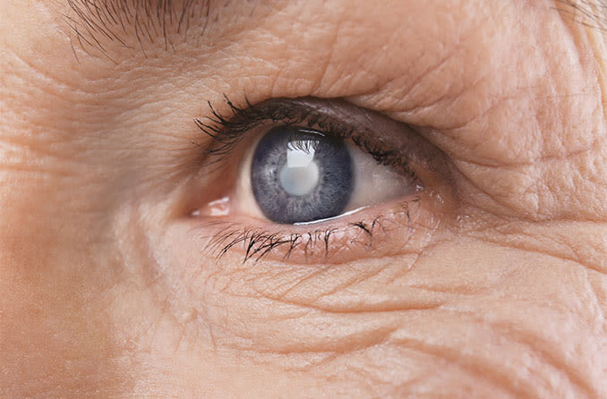 Photo of How To Fight Against Cataract