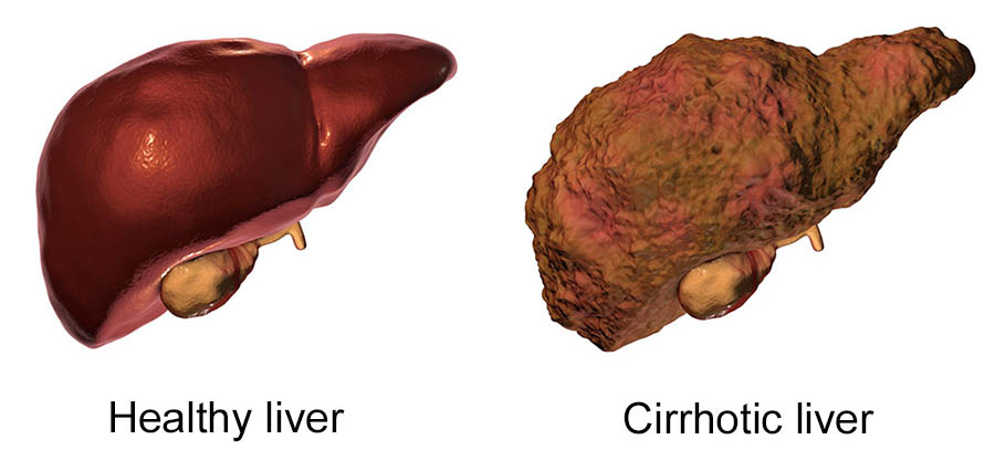 Photo of How to Prevent Cirrhosis of the Liver