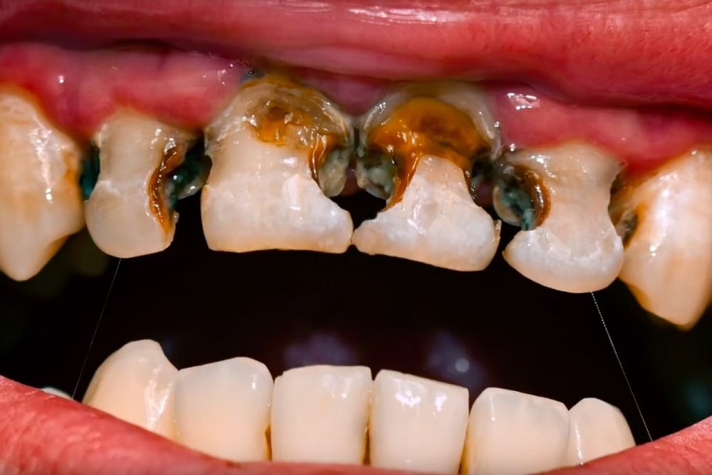 Photo of NATURAL REMEDY FOR TEETH DECAY AND BAD BREATH