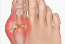 Photo of 6 HOME REMEDY FOR GOUT