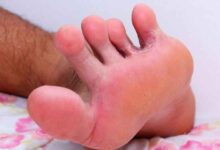 Photo of 9 EASY WAYS TO HEAL ATHLETE’S FOOT