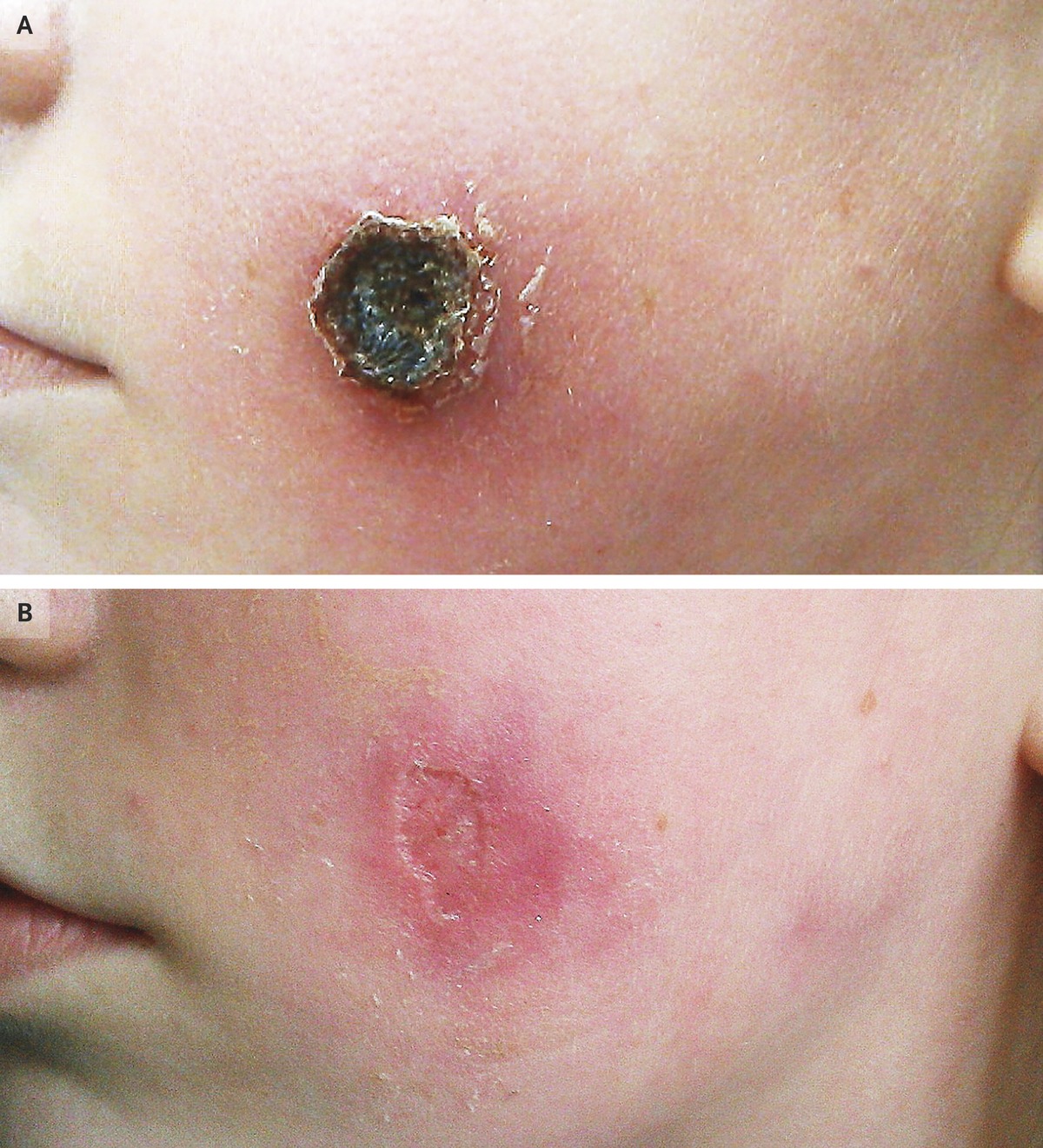Photo of Cowpox Infection Treatment And Control