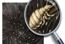 Photo of EFFECTIVE WAYS TO PREVENT HEAD LICE AT HOME