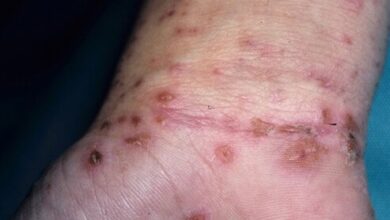 Photo of SCABIES NATURAL REMEDY, CAUSES, PREVENTION, SYMPTOMS