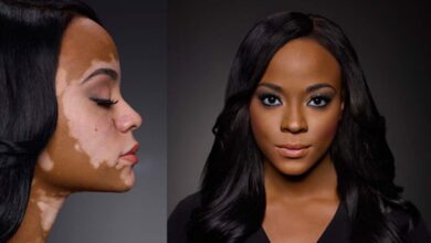 Photo of CAUSES, SYMTOMS AND TREATMENT FOR VITILIGO SKIN DISORDER