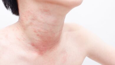 Photo of NATURAL TREATMENT FOR RASHES WITHOUT SIDE EFFECTS
