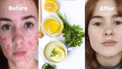 Photo of 100% FACE PIMPLE REMOVAL REMEDY