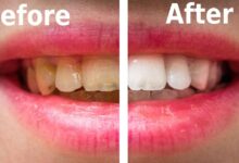Photo of HOW TOOTH DECAY CAN BE PREVENTED