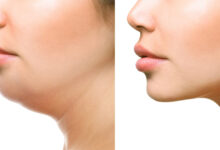 Photo of GET RID OF NECK FAT OVERNIGHT WITH THIS REMEDY
