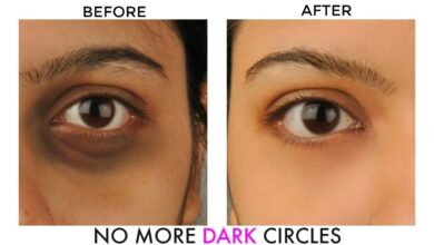 Photo of NATURAL WAYS TO REMOVE DARK CIRCLES UNDER THE EYES