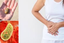Photo of NATURAL REMEDIES FOR GALLSTONES REMOVAL